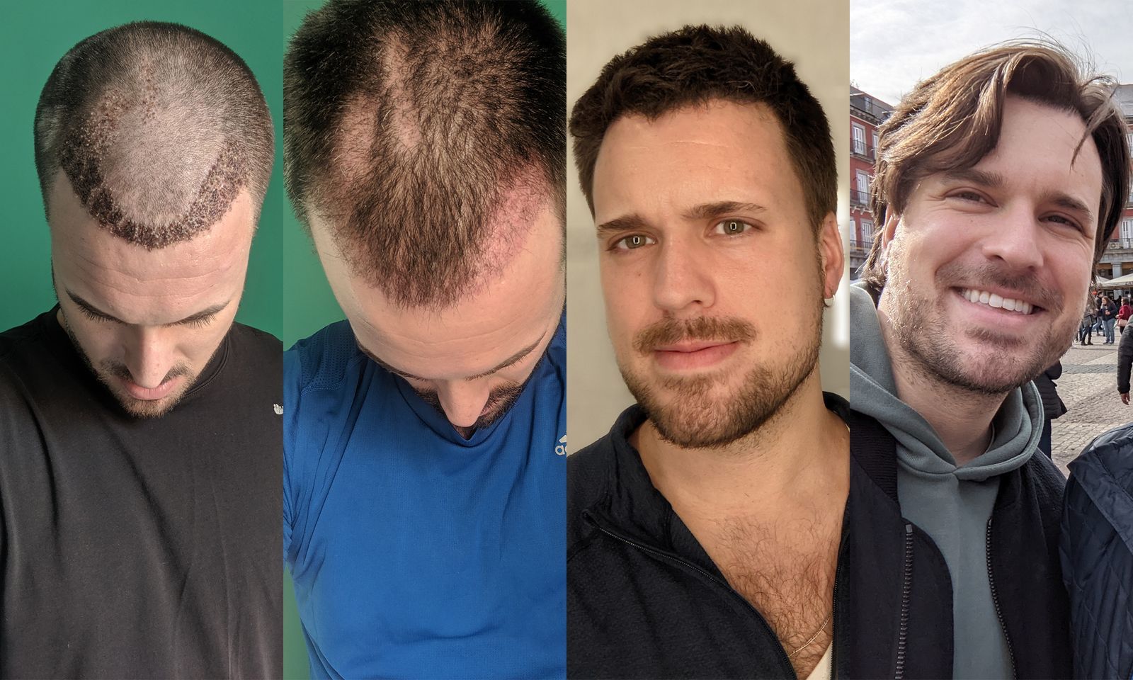 Hair Systems NYC Crafted for Real Results